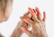 Rheumatoid Arthritis