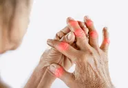 Rheumatoid Arthritis